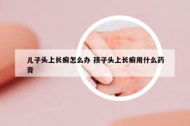 儿子头上长癣怎么办 孩子头上长癣用什么药膏