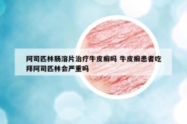 阿司匹林肠溶片治疗牛皮癣吗 牛皮癣患者吃拜阿司匹林会严重吗