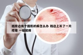裆旁边有个圆形的癣怎么办 裆边上长了一片疙瘩 一碰就痒