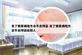 亲了银屑病地方会不会传染 亲了银屑病地方会不会传染给别人