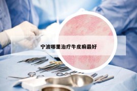 宁波哪里治疗牛皮癣最好
