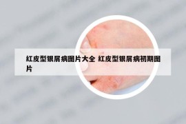 红皮型银屑病图片大全 红皮型银屑病初期图片