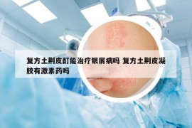 复方土荆皮酊能治疗银屑病吗 复方土荆皮凝胶有激素药吗