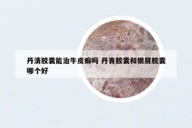 丹清胶囊能治牛皮癣吗 丹青胶囊和银屑胶囊哪个好