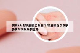 初发7天的银屑病怎么治疗 银屑病首次发病多长时间发展到全身