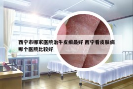 西宁市哪家医院治牛皮癣最好 西宁看皮肤病哪个医院比较好