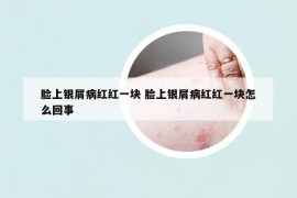 脸上银屑病红红一块 脸上银屑病红红一块怎么回事