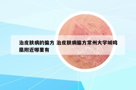 治皮肤病的偏方 治皮肤病偏方常州大学城鸣凰附近哪里有