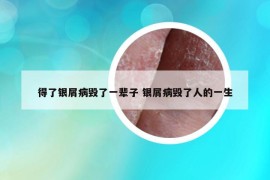 得了银屑病毁了一辈子 银屑病毁了人的一生