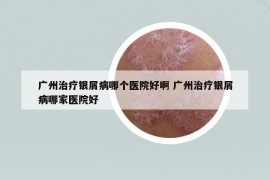 广州治疗银屑病哪个医院好啊 广州治疗银屑病哪家医院好