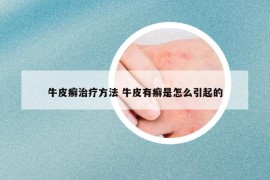 牛皮癣治疗方法 牛皮有癣是怎么引起的