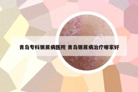青岛专科银屑病医院 青岛银屑病治疗哪家好