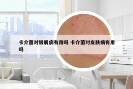 卡介菌对银屑病有用吗 卡介菌对皮肤病有用吗