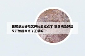 银屑病治好后又开始起红点了 银屑病治好后又开始起红点了正常吗