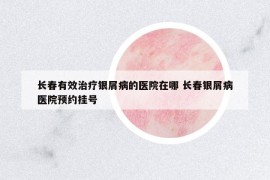 长春有效治疗银屑病的医院在哪 长春银屑病医院预约挂号