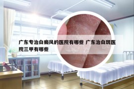 广东专治白癜风的医院有哪些 广东治白斑医院三甲有哪些