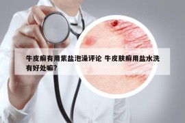 牛皮癣有用紫盐泡澡评论 牛皮肤癣用盐水洗有好处嘛?