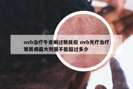 uvb治疗牛皮癣过敏反应 uvb光疗治疗银屑病最大剂量不能超过多少