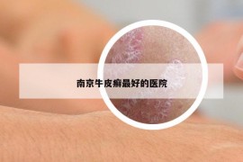 南京牛皮癣最好的医院