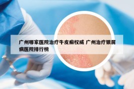 广州哪家医院治疗牛皮癣权威 广州治疗银屑病医院排行榜