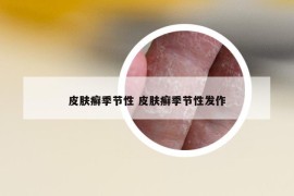 皮肤癣季节性 皮肤癣季节性发作