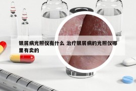银屑病光照仪有什么 治疗银屑病的光照仪哪里有卖的