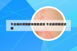 牛皮癣的初期都有哪些症状 牛皮癣初期症状图