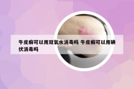牛皮癣可以用双氧水消毒吗 牛皮癣可以用碘伏消毒吗