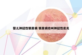婴儿神经性银屑病 银屑病也叫神经性皮炎