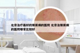 北京治疗最好的银屑病的医院 北京治银屑病的医院哪家比较好
