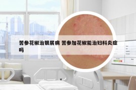 苦参花椒治银屑病 苦参加花椒能治妇科炎症吗