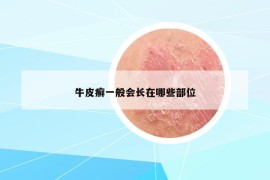 牛皮癣一般会长在哪些部位