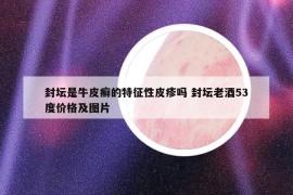 封坛是牛皮癣的特征性皮疹吗 封坛老酒53度价格及图片