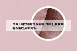白萝卜功效治疗牛皮癣吗 白萝卜,皮肤病,能不能吃,可以吃吗