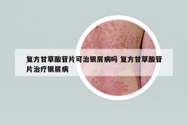 复方甘草酸苷片可治银屑病吗 复方甘草酸苷片治疗银屑病