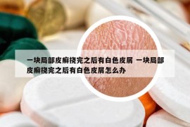 一块局部皮癣挠完之后有白色皮屑 一块局部皮癣挠完之后有白色皮屑怎么办