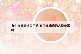 有牛皮癣能进工厂吗 有牛皮病癣的人能参军吗
