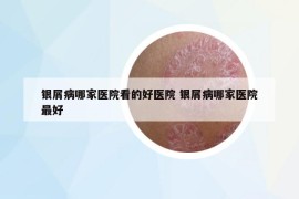 银屑病哪家医院看的好医院 银屑病哪家医院最好