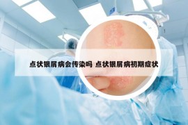 点状银屑病会传染吗 点状银屑病初期症状