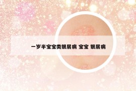 一岁半宝宝类银屑病 宝宝 银屑病