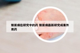 银屑病在研究中的药 银屑病最新研究成果外用药
