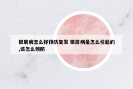 银屑病怎么样预防复发 银屑病是怎么引起的,该怎么预防