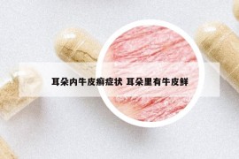 耳朵内牛皮癣症状 耳朵里有牛皮鲜