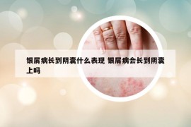 银屑病长到阴囊什么表现 银屑病会长到阴囊上吗