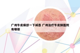 广州牛皮癣舒一下诚恳 广州治疗牛皮鲜医院有哪些