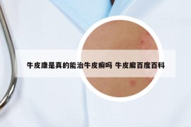 牛皮康是真的能治牛皮癣吗 牛皮廨百度百科