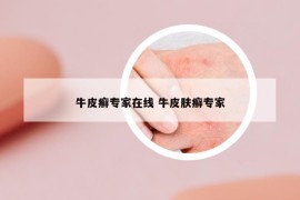 牛皮癣专家在线 牛皮肤癣专家