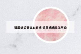 银屑病关节炎心脏病 银屑病病性关节炎