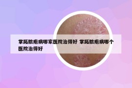 掌跖脓疱病哪家医院治得好 掌跖脓疱病哪个医院治得好