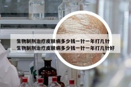 生物制剂治疗皮肤病多少钱一针一年打几针 生物制剂治疗皮肤病多少钱一针一年打几针好